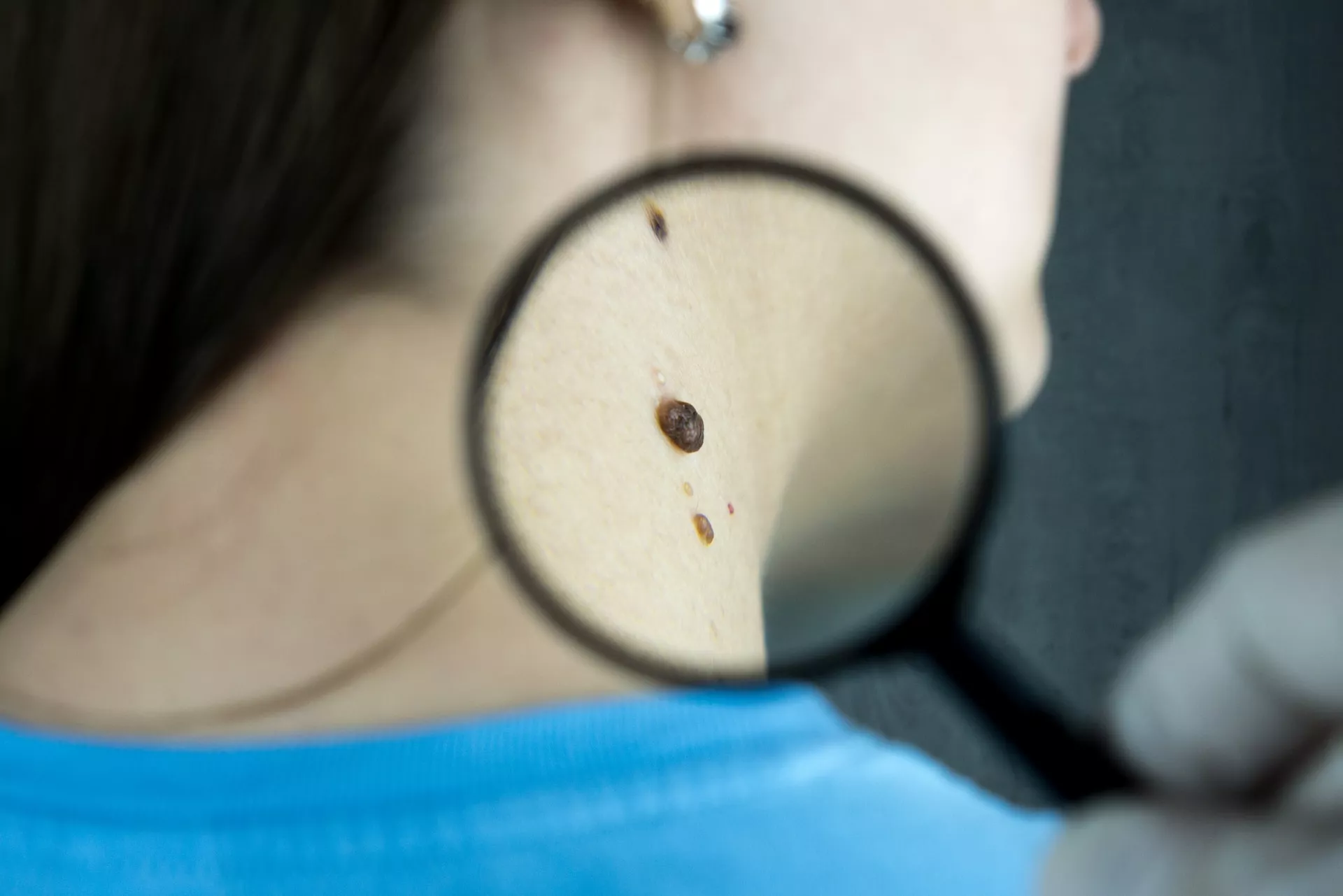 CUÁLES SON LOS SÍNTOMAS DE UN CARCINOMA QUE NO DEBES IGNORAR