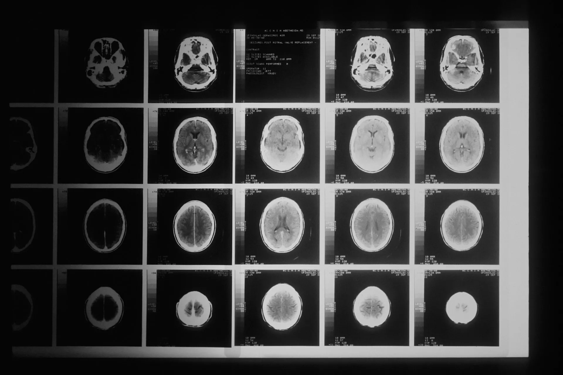 DÌA INTERNACIONAL DE LOS TUMORES CEREBRALES, CONCIENTIZACIÒN Y ESPERANZA