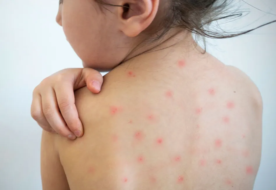 ALERTA POR SARAMPIÓN: UN CASO SIN ORIGEN CLARO ACTIVÓ UN OPERATIVO SANITARIO EN ENTRE RÍOS Y CASILDA